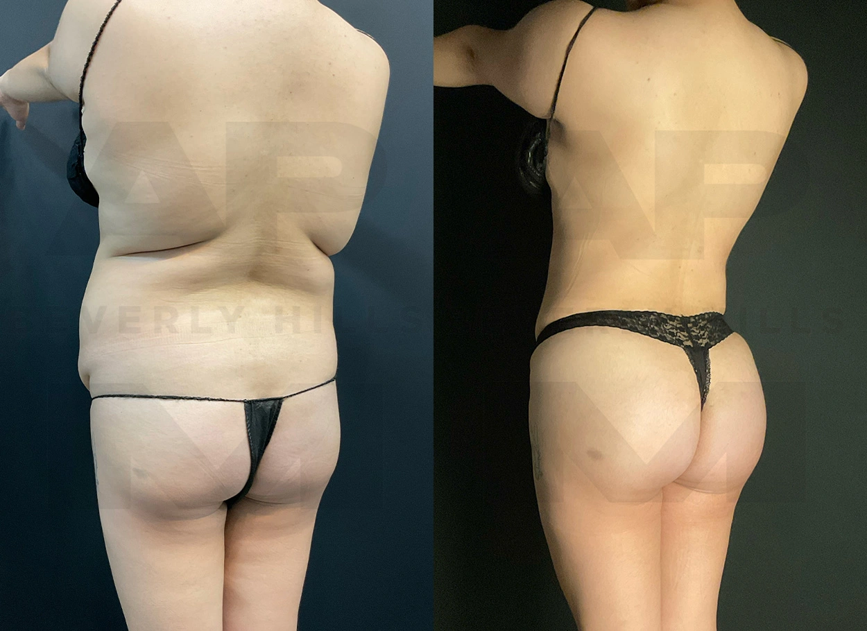 Real Patient Results by Dr. Marshall or Andrew P. Marshall Plastic Surgery serving Beverly Hills & Los Angeles, CA