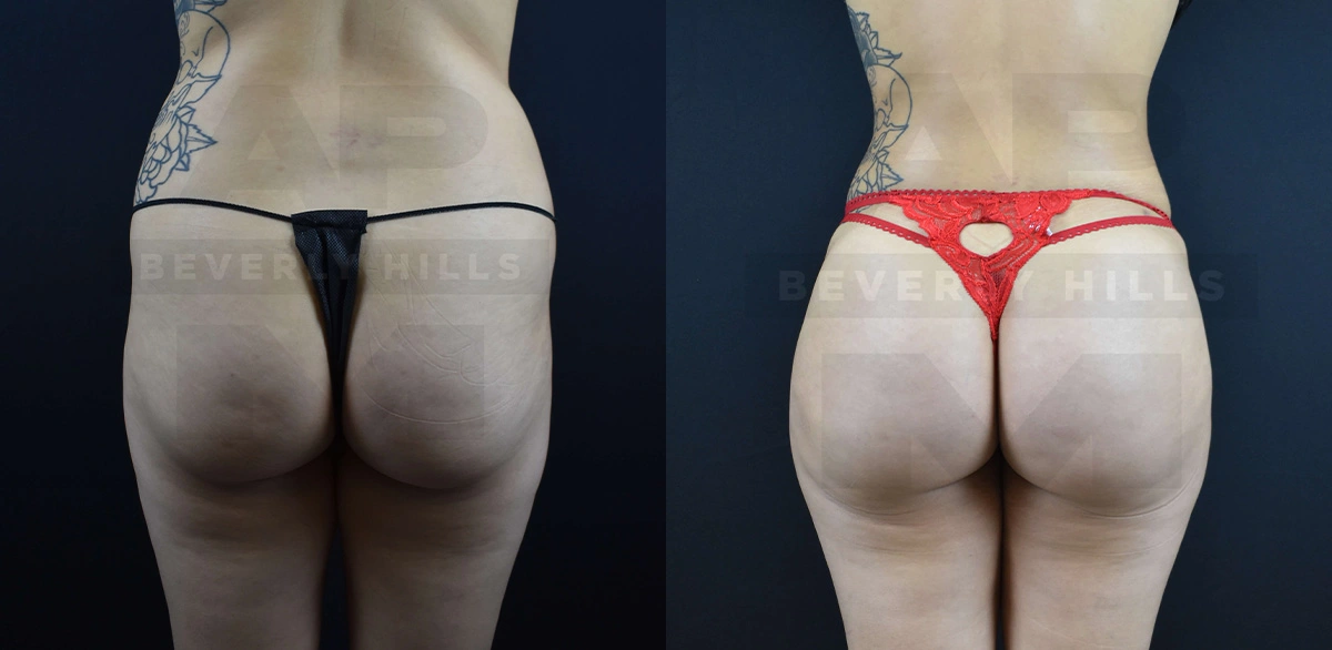 Real Patient Results of Dr. Andre P. Marshall providing Plastic Surgery services to his Beverly Hills & Los Angeles patients.