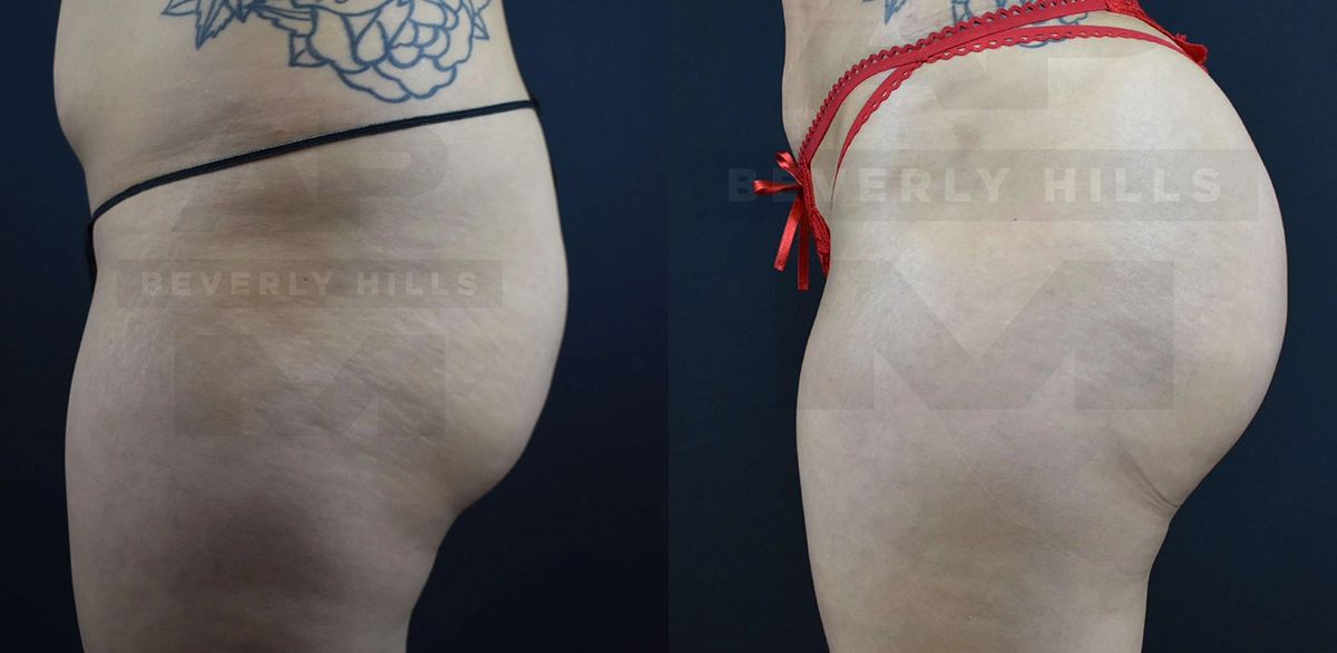 Real Patient Results of Dr. Andre P. Marshall providing Plastic Surgery services to his Beverly Hills & Los Angeles patients.