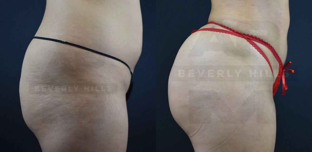 Real Patient Results of Dr. Andre P. Marshall providing Plastic Surgery services to his Beverly Hills & Los Angeles patients.