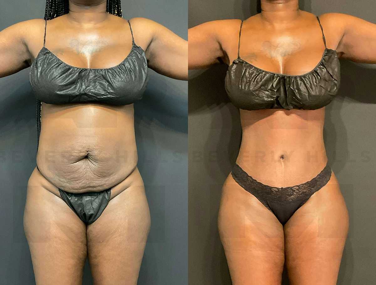 Real Patient Results of Dr. Andre P. Marshall providing Plastic Surgery services to his Beverly Hills & Los Angeles patients.