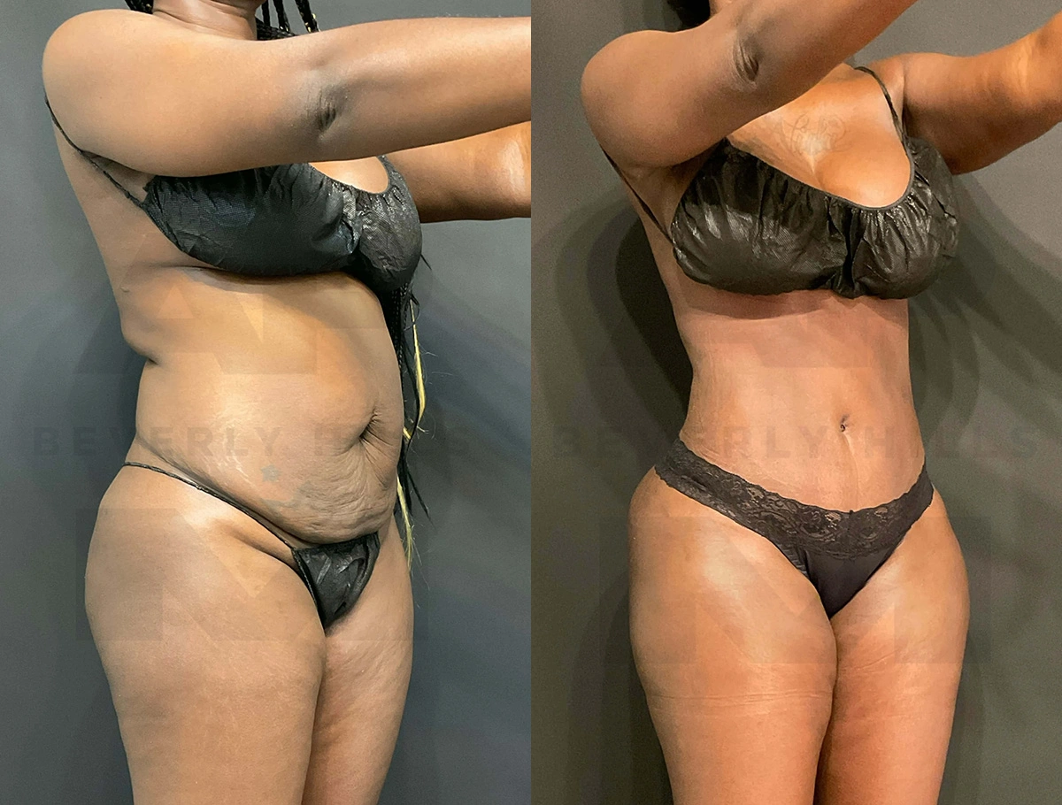 Real Patient Results of Dr. Andre P. Marshall providing Plastic Surgery services to his Beverly Hills & Los Angeles patients.