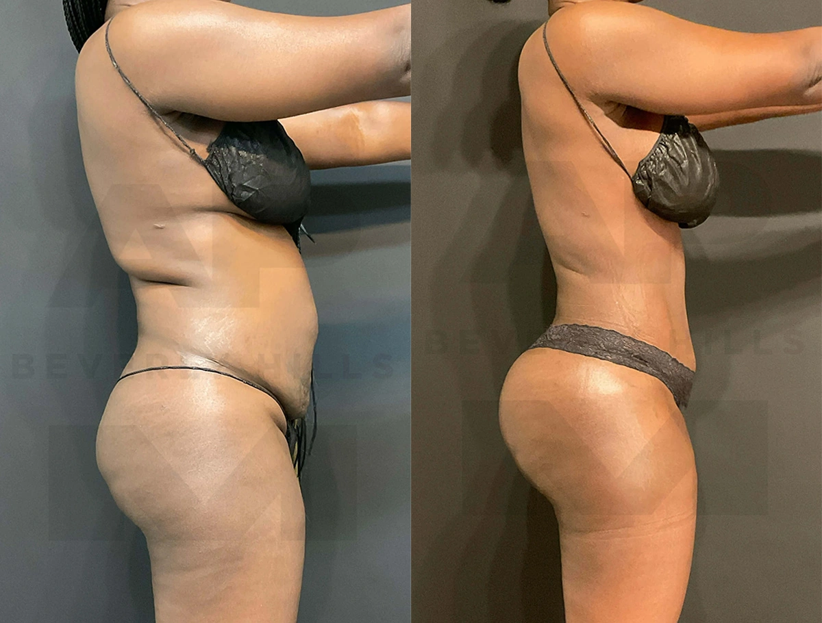 Real Patient Results of Dr. Andre P. Marshall providing Plastic Surgery services to his Beverly Hills & Los Angeles patients.