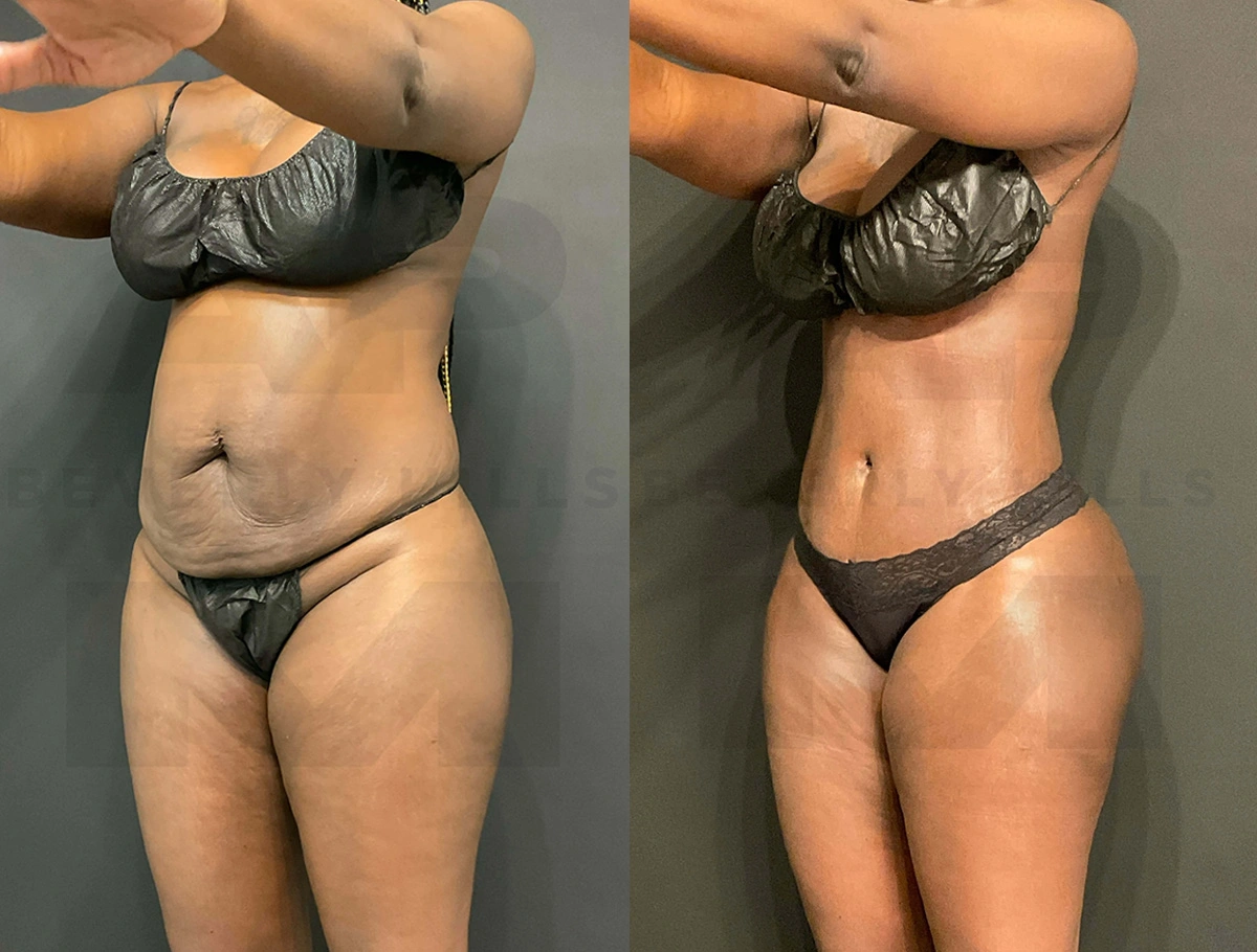 Real Patient Results of Dr. Andre P. Marshall providing Plastic Surgery services to his Beverly Hills & Los Angeles patients.