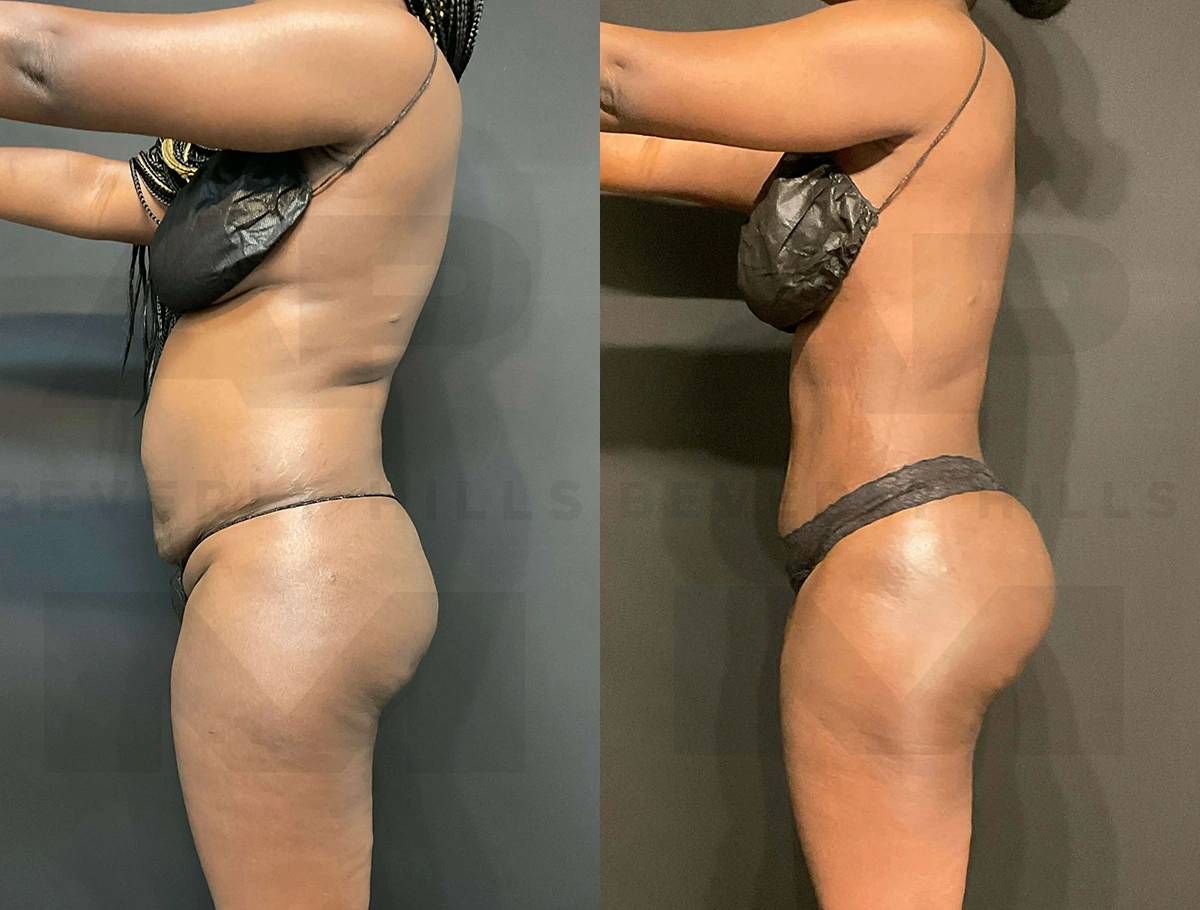 Real Patient Results of Dr. Andre P. Marshall providing Plastic Surgery services to his Beverly Hills & Los Angeles patients.