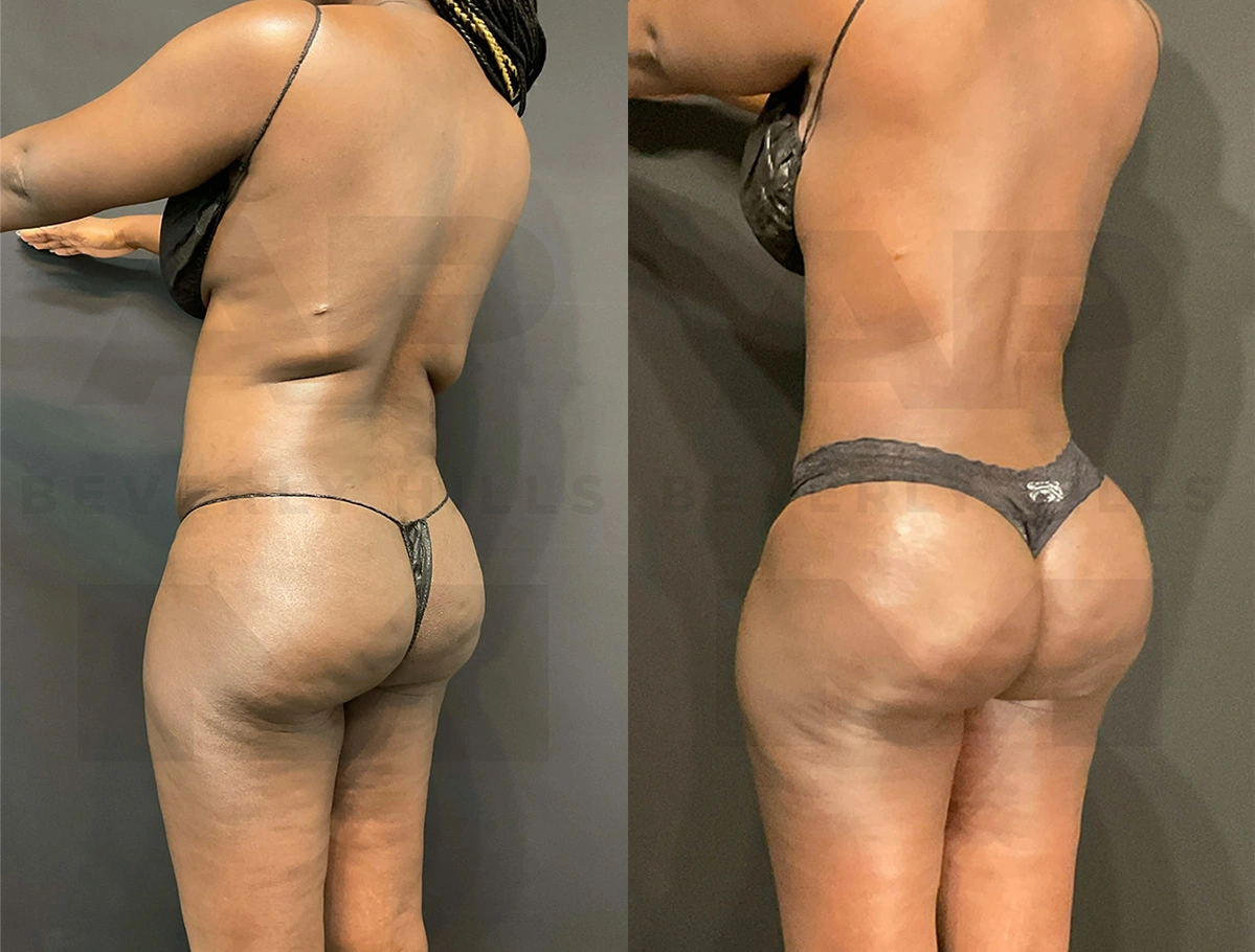 Real Patient Results of Dr. Andre P. Marshall providing Plastic Surgery services to his Beverly Hills & Los Angeles patients.