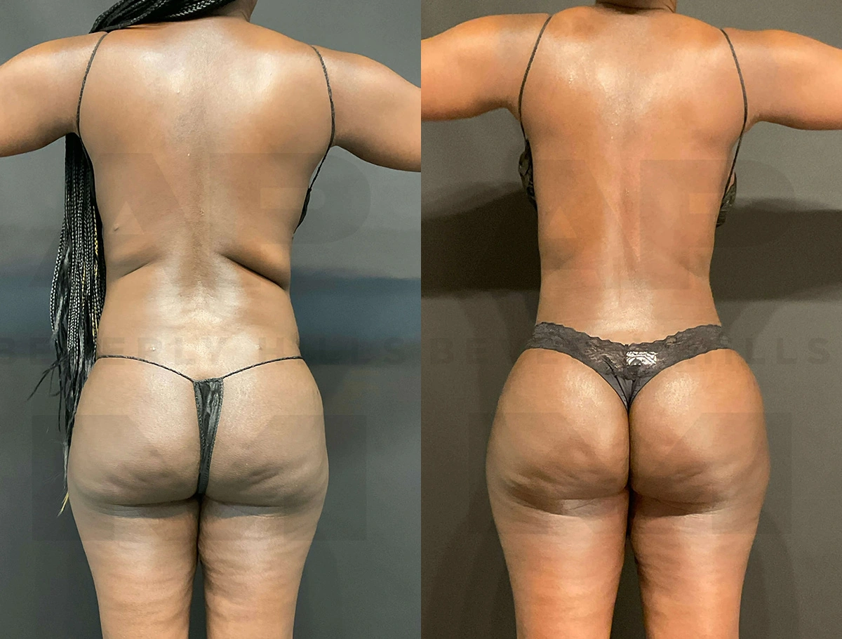 Real Patient Results of Dr. Andre P. Marshall providing Plastic Surgery services to his Beverly Hills & Los Angeles patients.