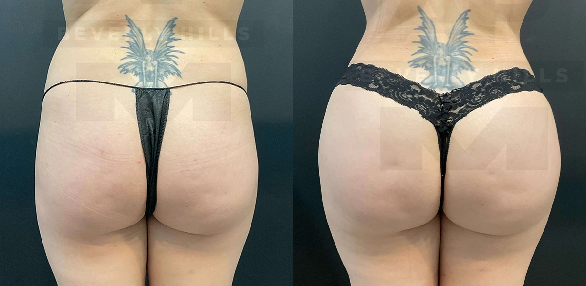 Real Patient Results of Dr. Andre P. Marshall providing Plastic Surgery services to his Beverly Hills & Los Angeles patients.