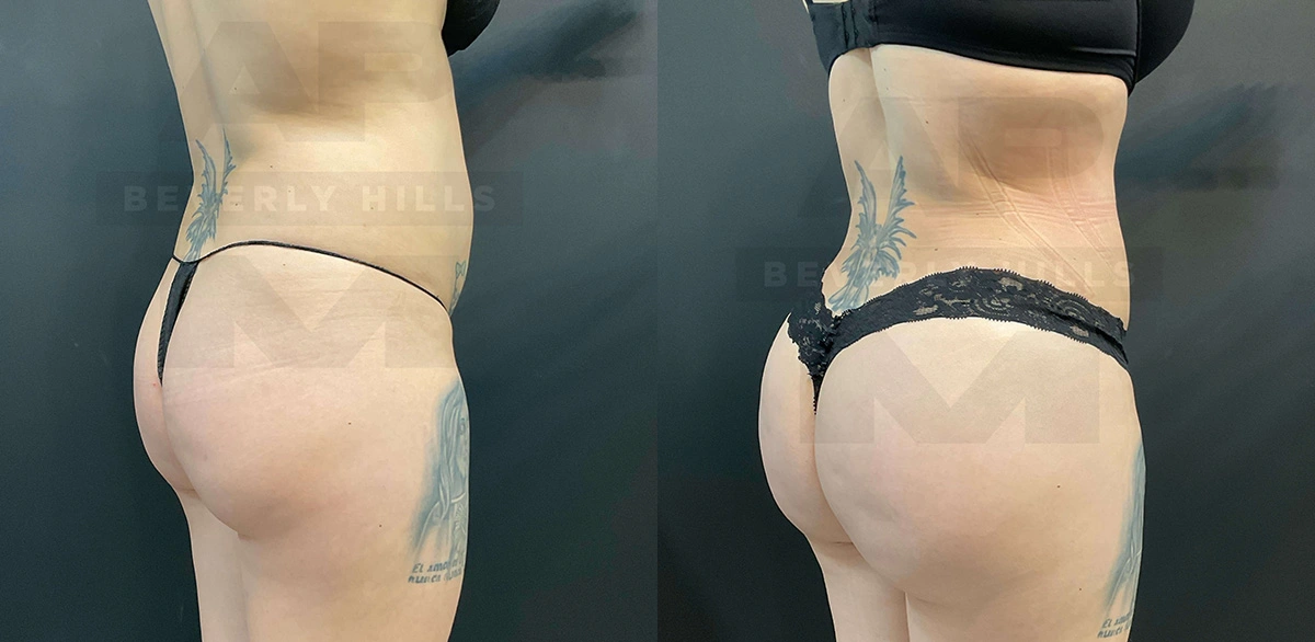 Real Patient Results of Dr. Andre P. Marshall providing Plastic Surgery services to his Beverly Hills & Los Angeles patients.