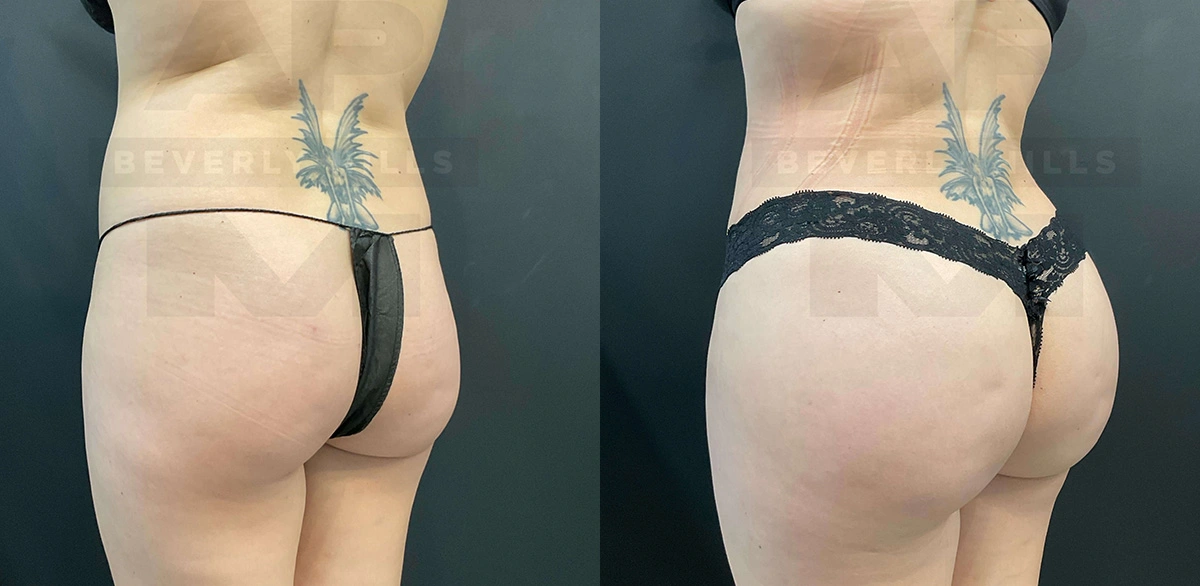 Real Patient Results of Dr. Andre P. Marshall providing Plastic Surgery services to his Beverly Hills & Los Angeles patients.