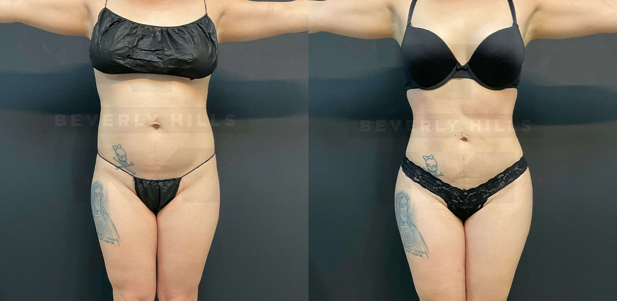 Real Patient Results of Dr. Andre P. Marshall providing Plastic Surgery services to his Beverly Hills & Los Angeles patients.