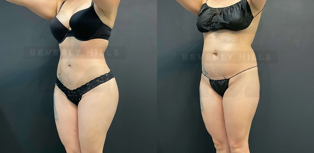 Real Patient Results of Dr. Andre P. Marshall providing Plastic Surgery services to his Beverly Hills & Los Angeles patients.