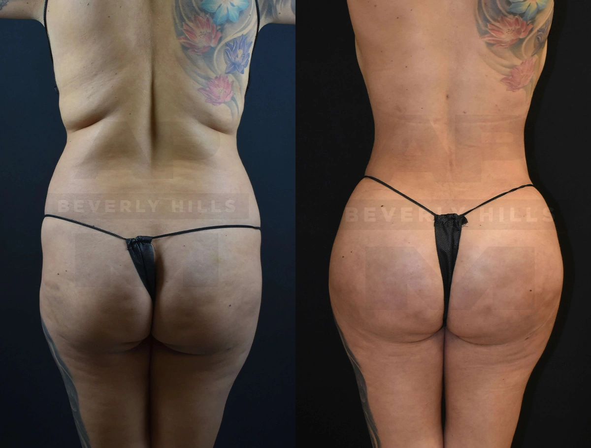 Real Patient Results of Dr. Andre P. Marshall providing Plastic Surgery services to his Beverly Hills & Los Angeles patients.