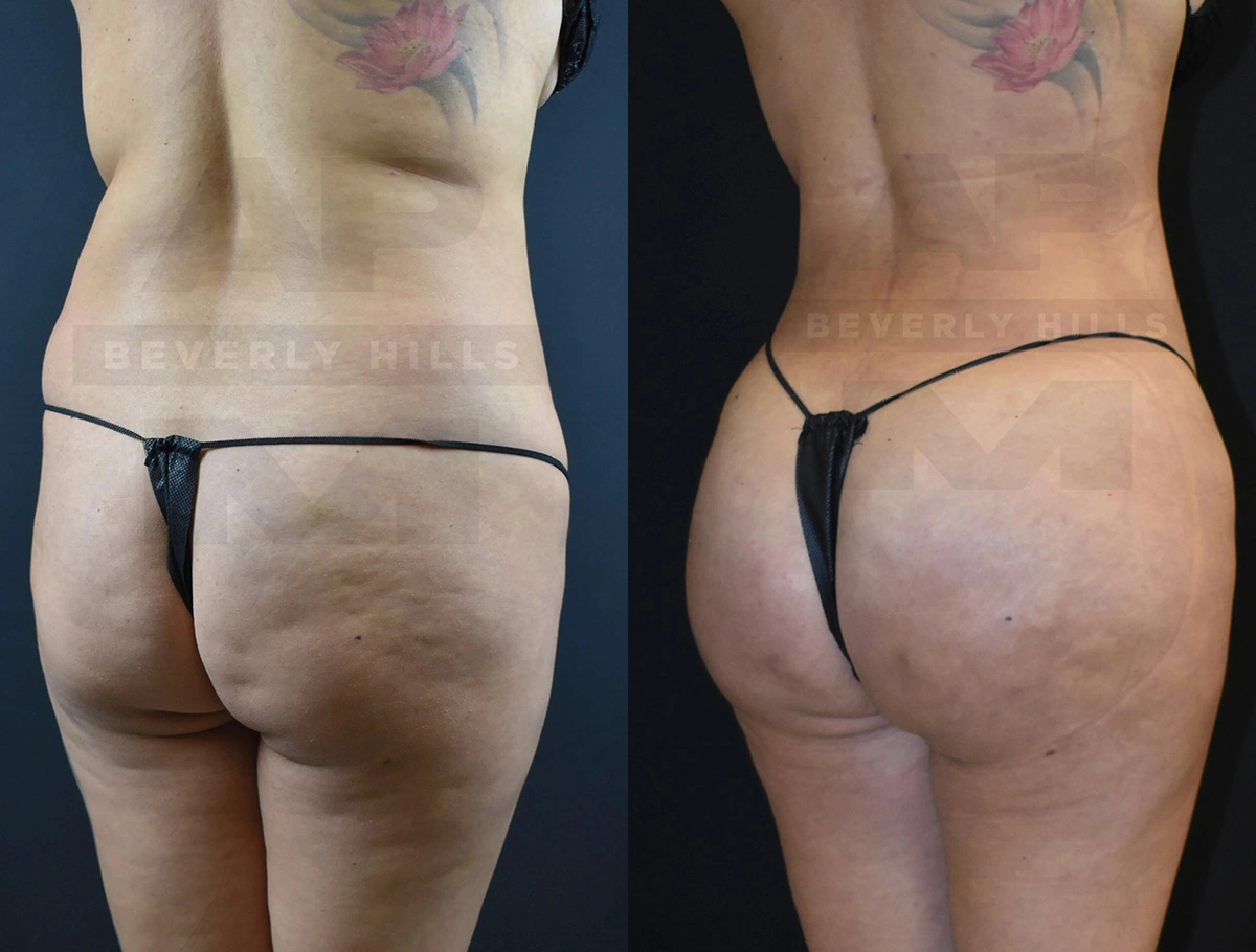 Real Patient Results of Dr. Andre P. Marshall providing Plastic Surgery services to his Beverly Hills & Los Angeles patients.