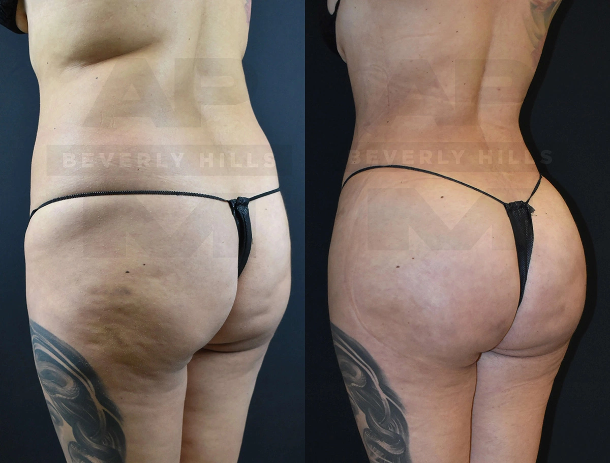 Real Patient Results of Dr. Andre P. Marshall providing Plastic Surgery services to his Beverly Hills & Los Angeles patients.