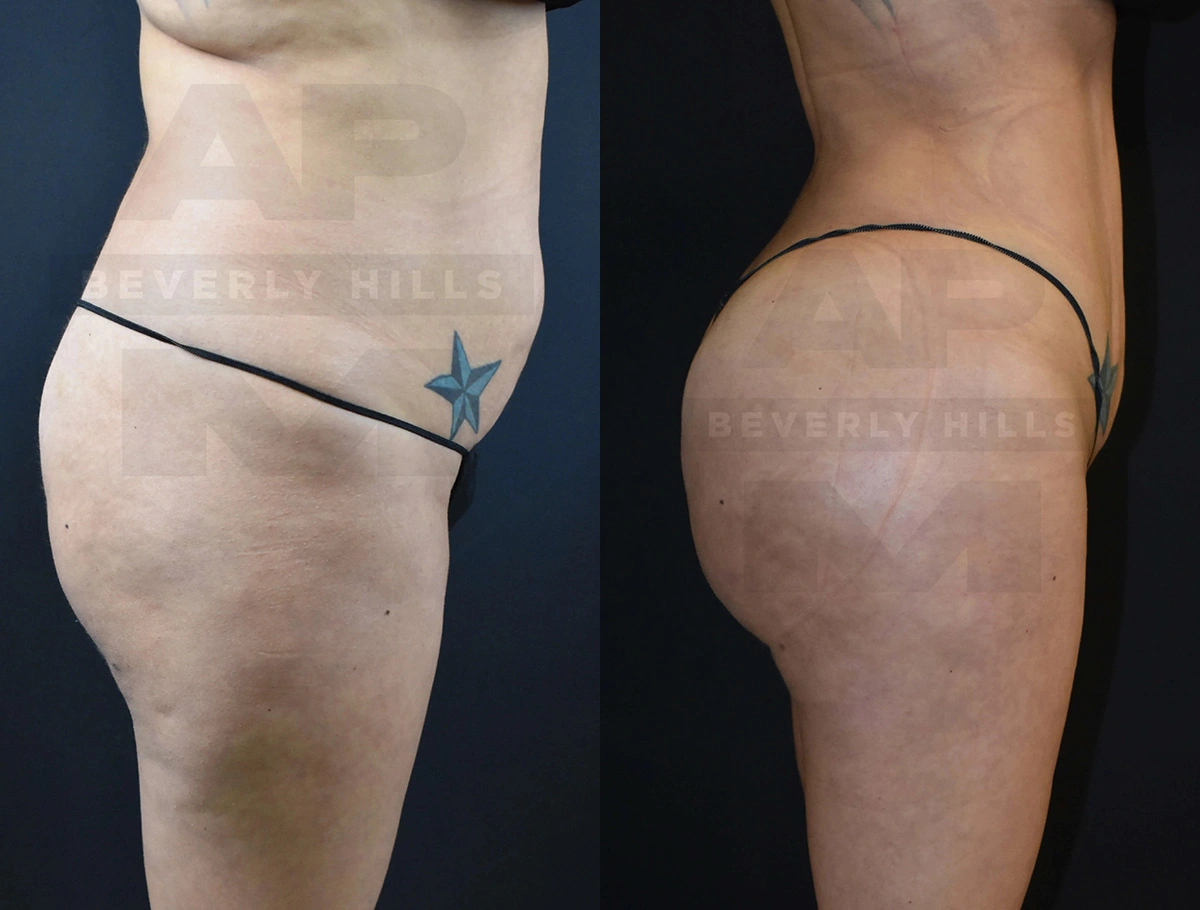 Real Patient Results of Dr. Andre P. Marshall providing Plastic Surgery services to his Beverly Hills & Los Angeles patients.