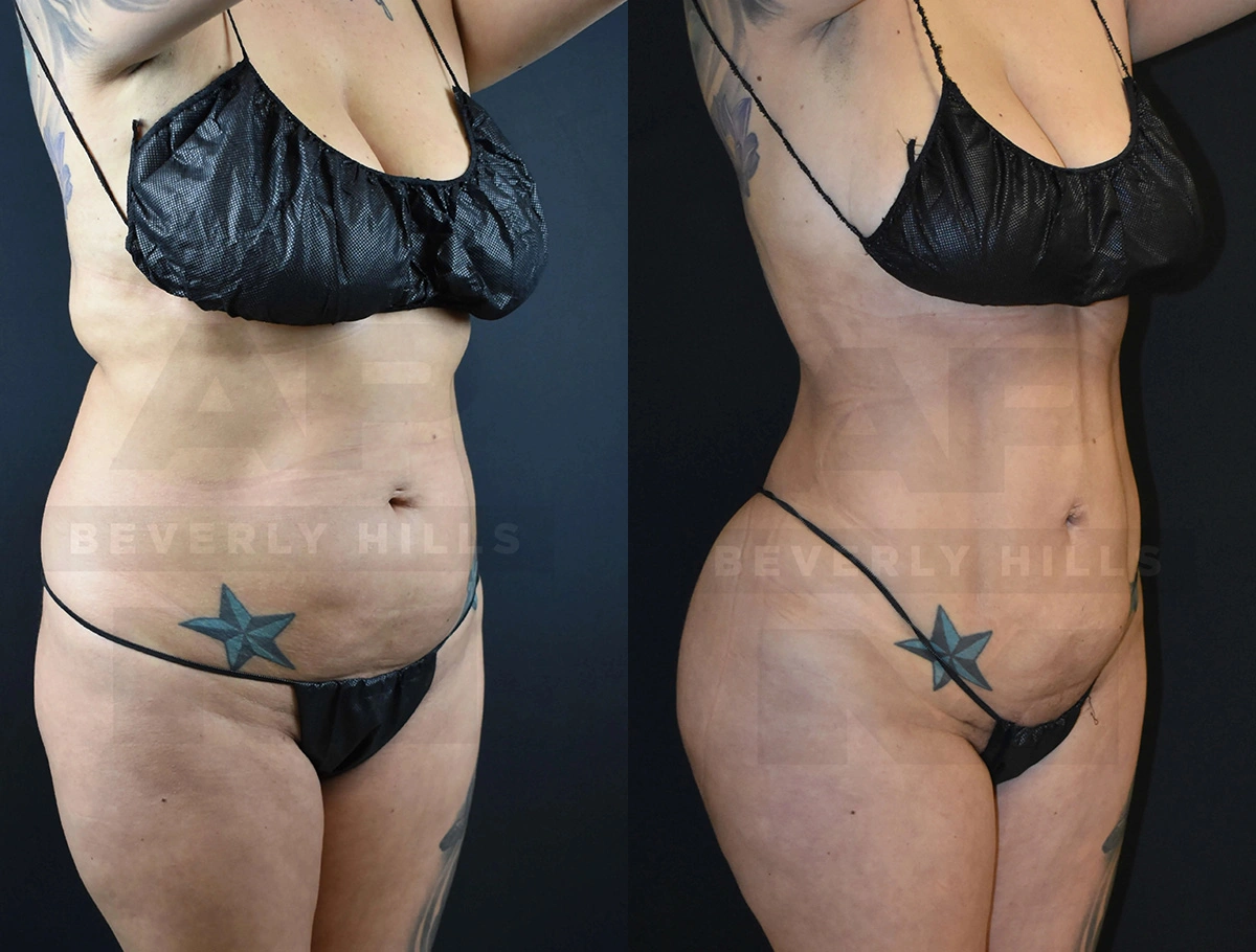 Real Patient Results of Dr. Andre P. Marshall providing Plastic Surgery services to his Beverly Hills & Los Angeles patients.