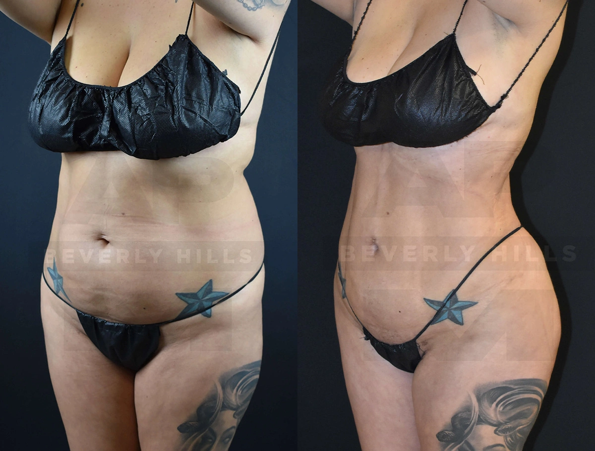 Real Patient Results of Dr. Andre P. Marshall providing Plastic Surgery services to his Beverly Hills & Los Angeles patients.