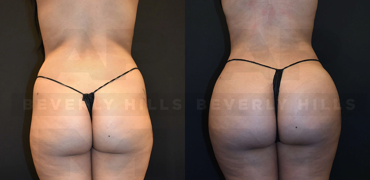 Real Patient Results of Dr. Andre P. Marshall providing Plastic Surgery services to his Beverly Hills & Los Angeles patients.