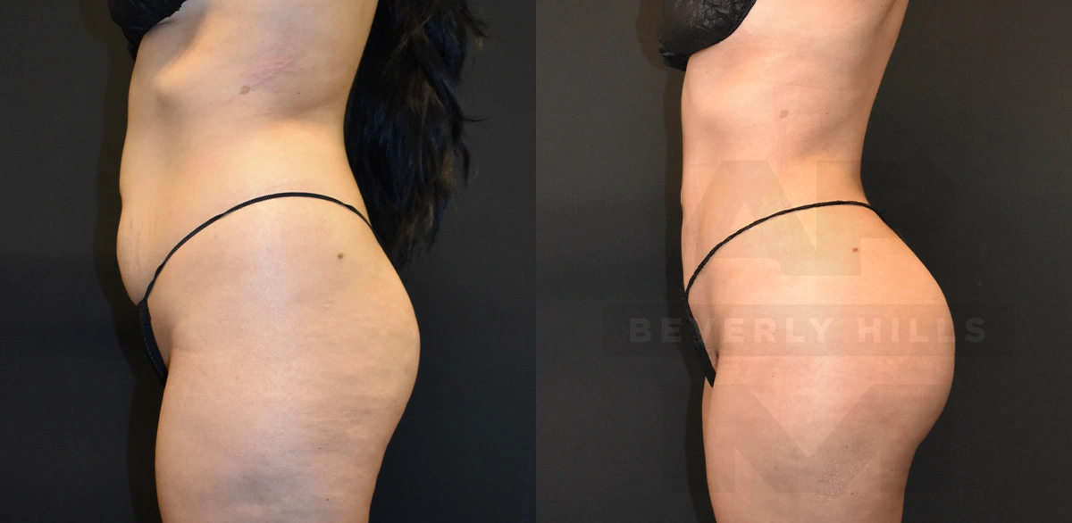 Real Patient Results of Dr. Andre P. Marshall providing Plastic Surgery services to his Beverly Hills & Los Angeles patients.