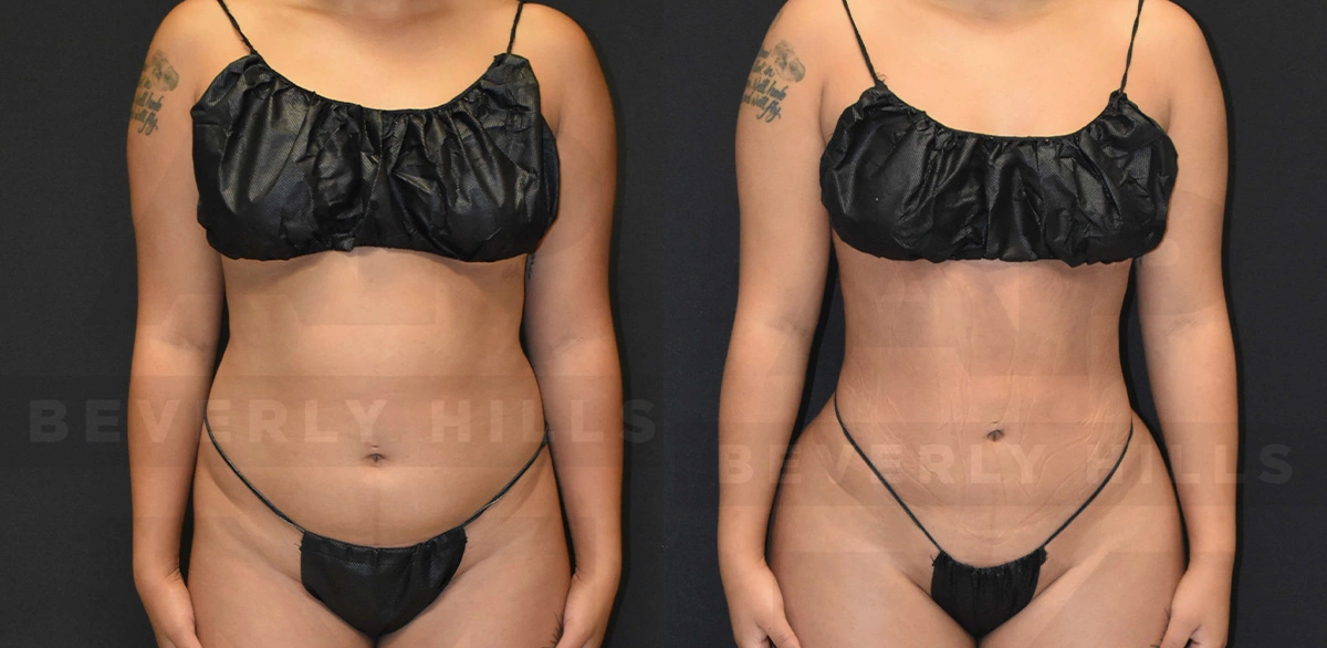 Real Patient Results of Dr. Andre P. Marshall providing Plastic Surgery services to his Beverly Hills & Los Angeles patients.