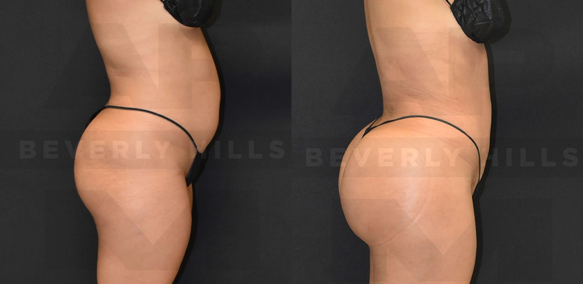 Real Patient Results of Dr. Andre P. Marshall providing Plastic Surgery services to his Beverly Hills & Los Angeles patients.