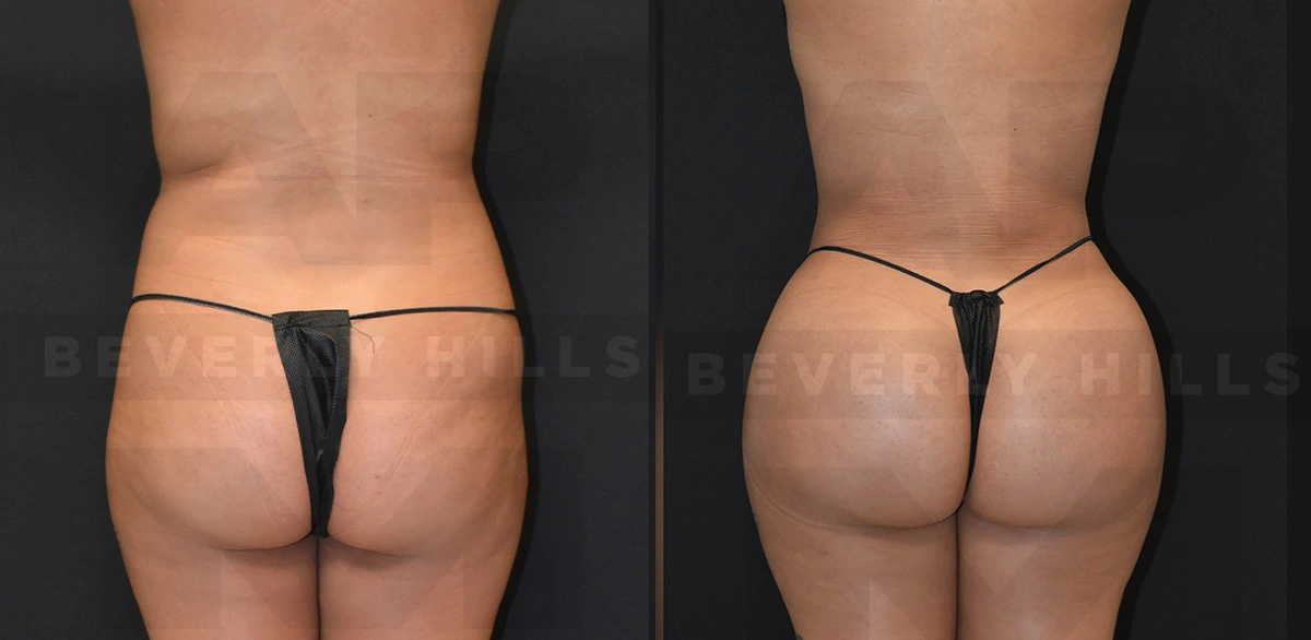 Real Patient Results of Dr. Andre P. Marshall providing Plastic Surgery services to his Beverly Hills & Los Angeles patients.