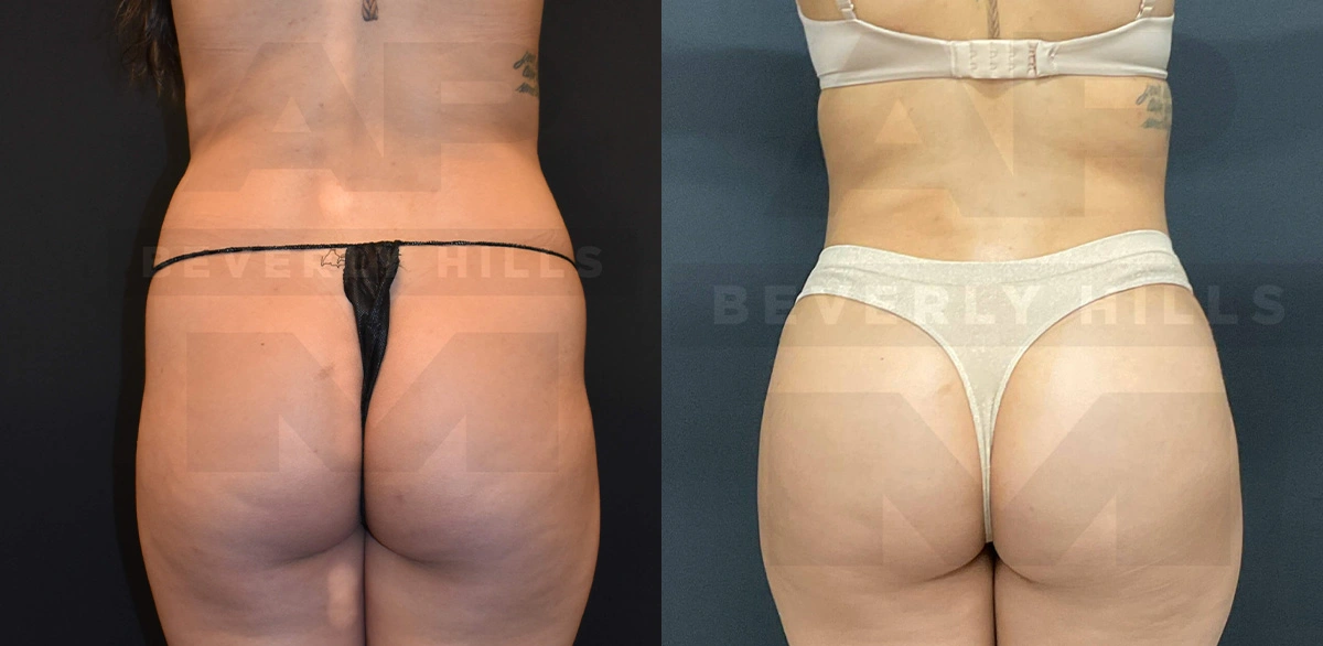 Real Patient Results of Dr. Andre P. Marshall providing Plastic Surgery services to his Beverly Hills & Los Angeles patients.