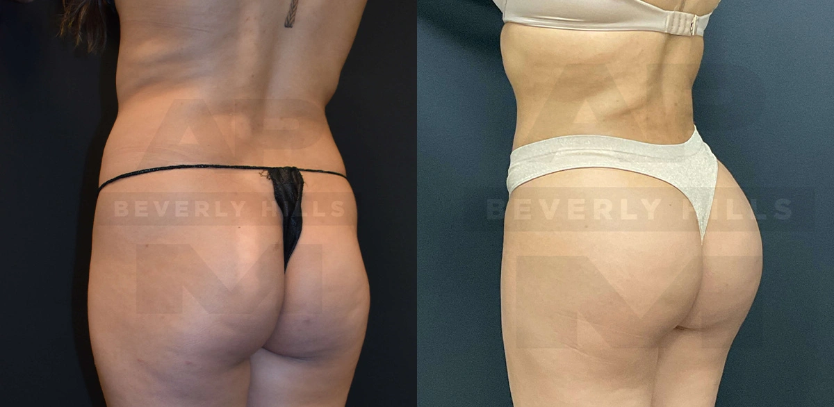 Real Patient Results of Dr. Andre P. Marshall providing Plastic Surgery services to his Beverly Hills & Los Angeles patients.