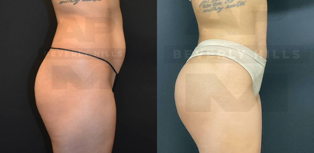 Real Patient Results of Dr. Andre P. Marshall providing Plastic Surgery services to his Beverly Hills & Los Angeles patients.