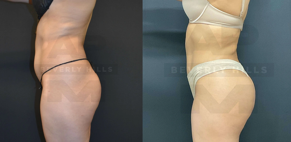 Real Patient Results of Dr. Andre P. Marshall providing Plastic Surgery services to his Beverly Hills & Los Angeles patients.