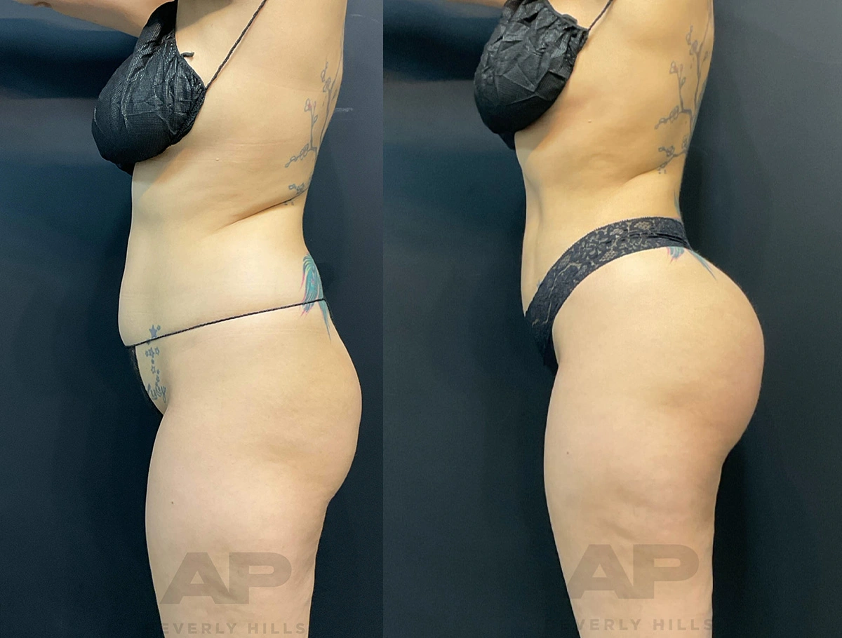 Real Patient Results of Dr. Andre P. Marshall providing Plastic Surgery services to his Beverly Hills & Los Angeles patients.