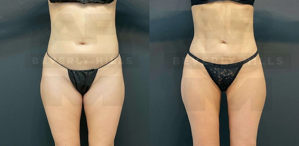 Real Patient Results of Dr. Andre P. Marshall providing Plastic Surgery services to his Beverly Hills & Los Angeles patients.