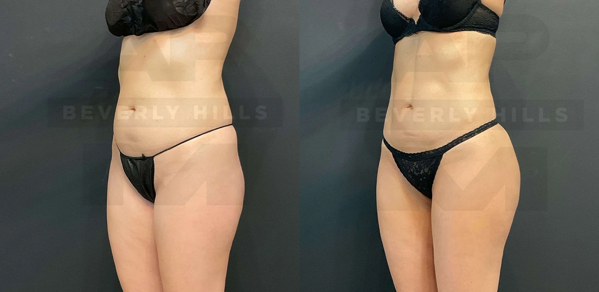 Real Patient Results of Dr. Andre P. Marshall providing Plastic Surgery services to his Beverly Hills & Los Angeles patients.