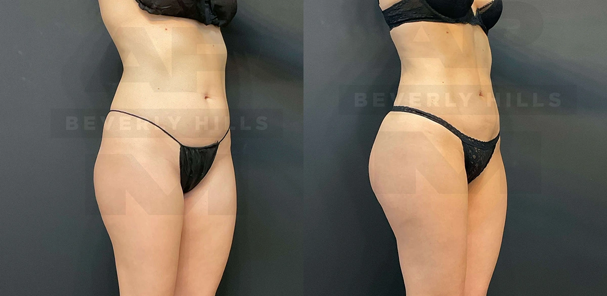 Real Patient Results of Dr. Andre P. Marshall providing Plastic Surgery services to his Beverly Hills & Los Angeles patients.