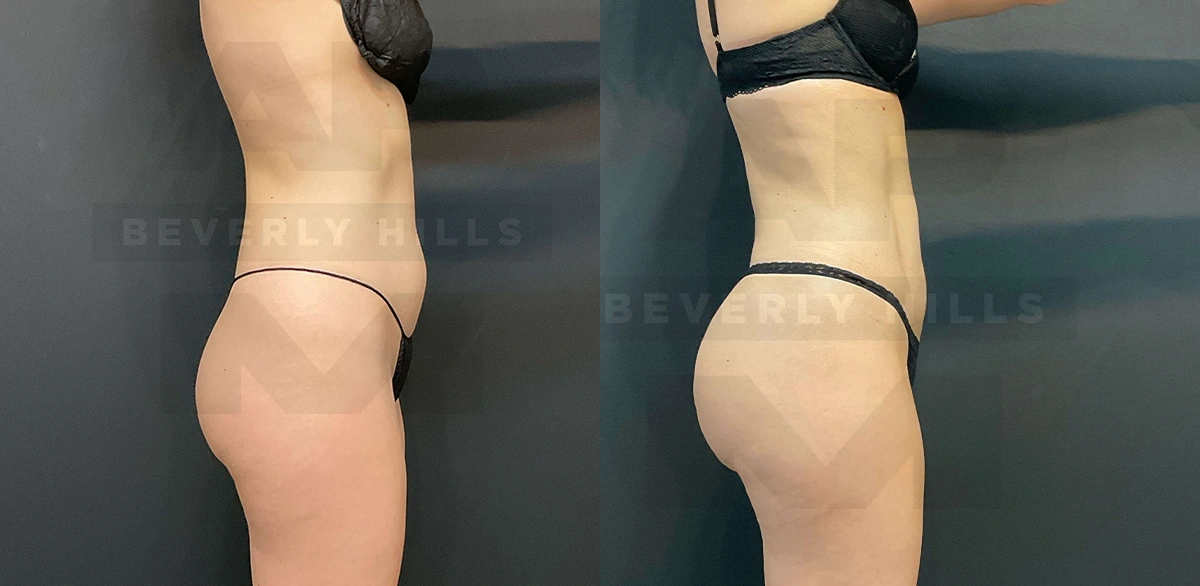 Real Patient Results of Dr. Andre P. Marshall providing Plastic Surgery services to his Beverly Hills & Los Angeles patients.