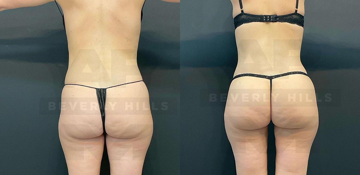 Real Patient Results of Dr. Andre P. Marshall providing Plastic Surgery services to his Beverly Hills & Los Angeles patients.