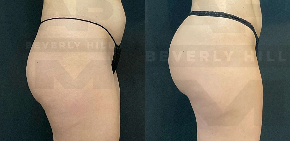 Real Patient Results of Dr. Andre P. Marshall providing Plastic Surgery services to his Beverly Hills & Los Angeles patients.