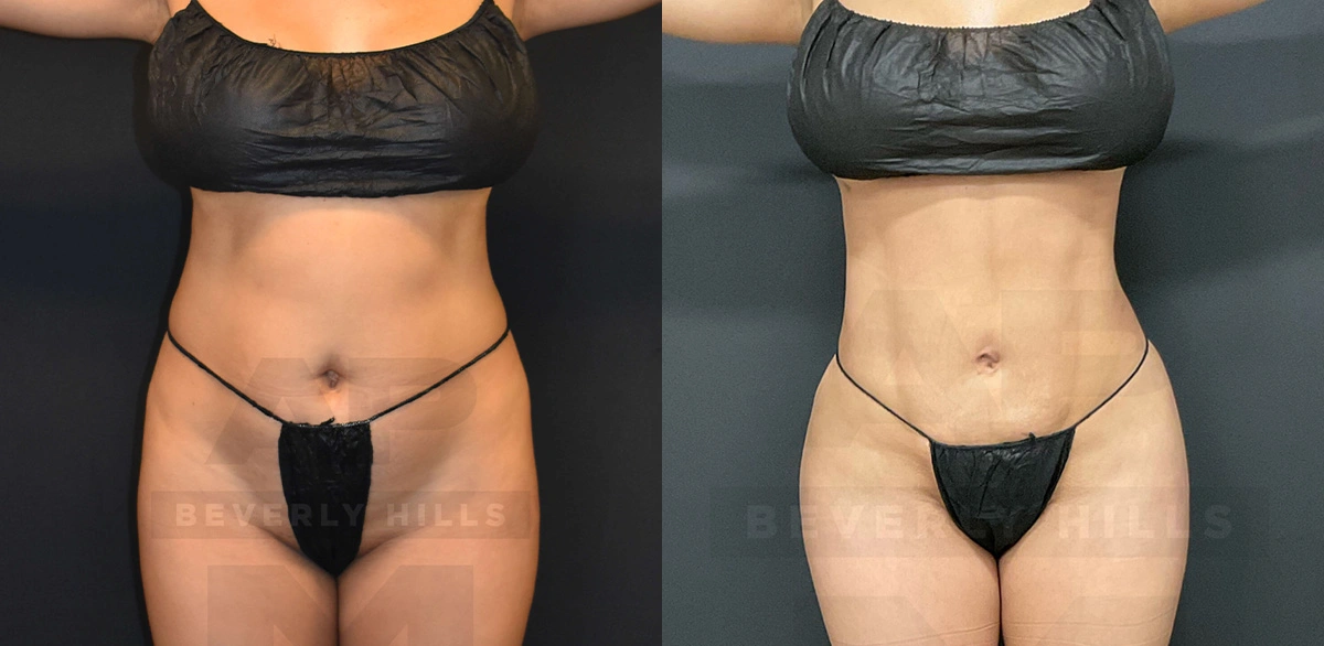 Real Patient Results of Dr. Andre P. Marshall providing Plastic Surgery services to his Beverly Hills & Los Angeles patients.