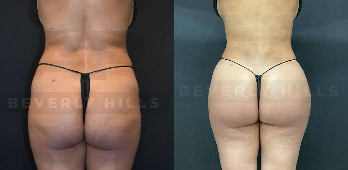 Real Patient Results of Dr. Andre P. Marshall providing Plastic Surgery services to his Beverly Hills & Los Angeles patients.