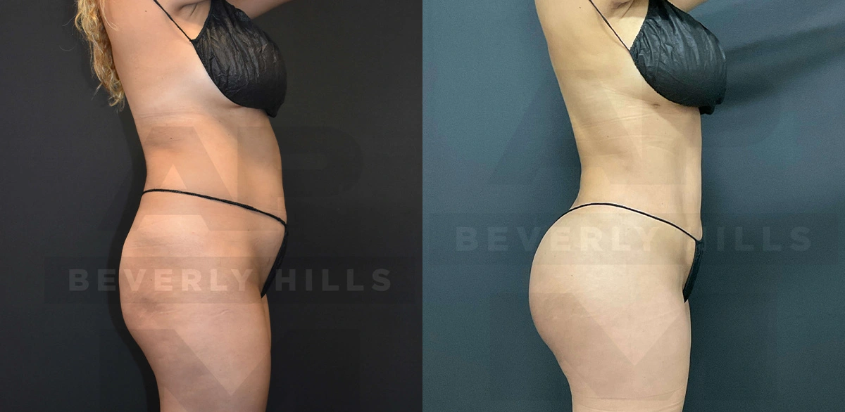 Real Patient Results of Dr. Andre P. Marshall providing Plastic Surgery services to his Beverly Hills & Los Angeles patients.