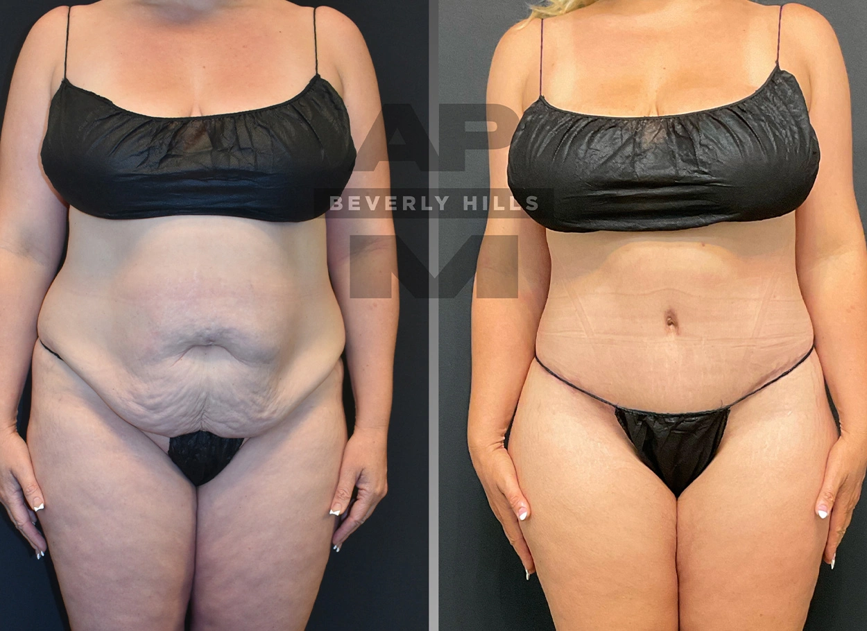 Real Patient Results by Dr. Marshall or Andrew P. Marshall Plastic Surgery serving Beverly Hills & Los Angeles, CA