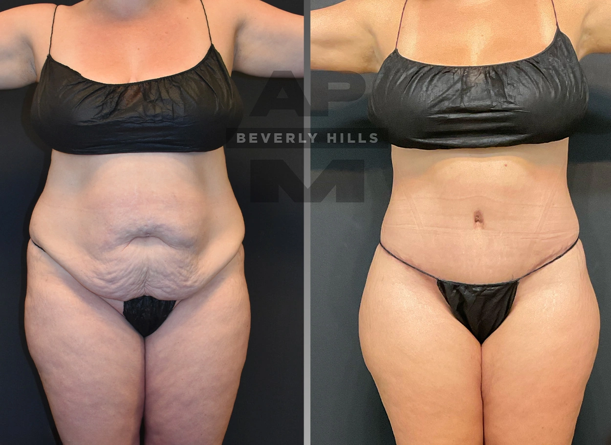 Real Patient Results by Dr. Marshall or Andrew P. Marshall Plastic Surgery serving Beverly Hills & Los Angeles, CA