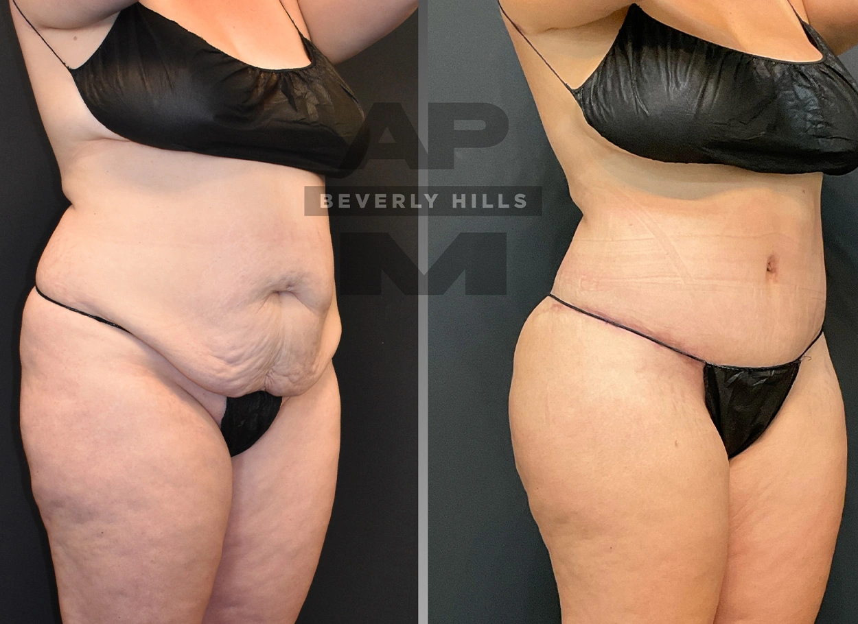 Real Patient Results by Dr. Marshall or Andrew P. Marshall Plastic Surgery serving Beverly Hills & Los Angeles, CA