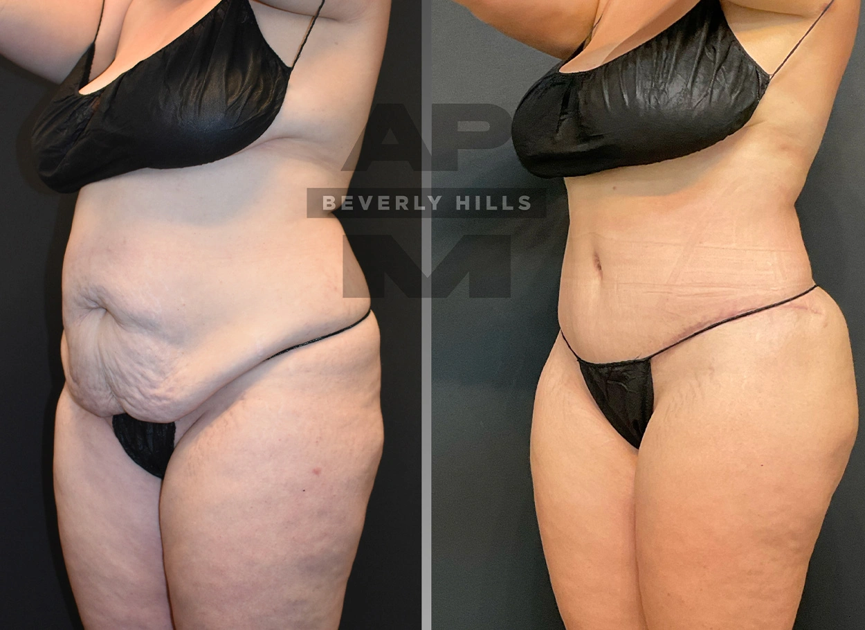 Real Patient Results by Dr. Marshall or Andrew P. Marshall Plastic Surgery serving Beverly Hills & Los Angeles, CA