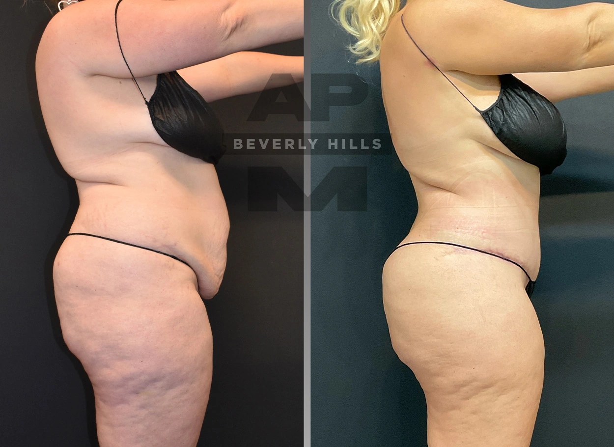 Real Patient Results by Dr. Marshall or Andrew P. Marshall Plastic Surgery serving Beverly Hills & Los Angeles, CA