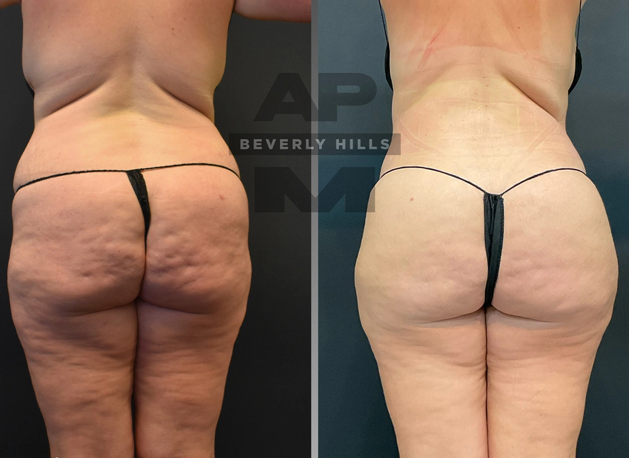 Real Patient Results by Dr. Marshall or Andrew P. Marshall Plastic Surgery serving Beverly Hills & Los Angeles, CA