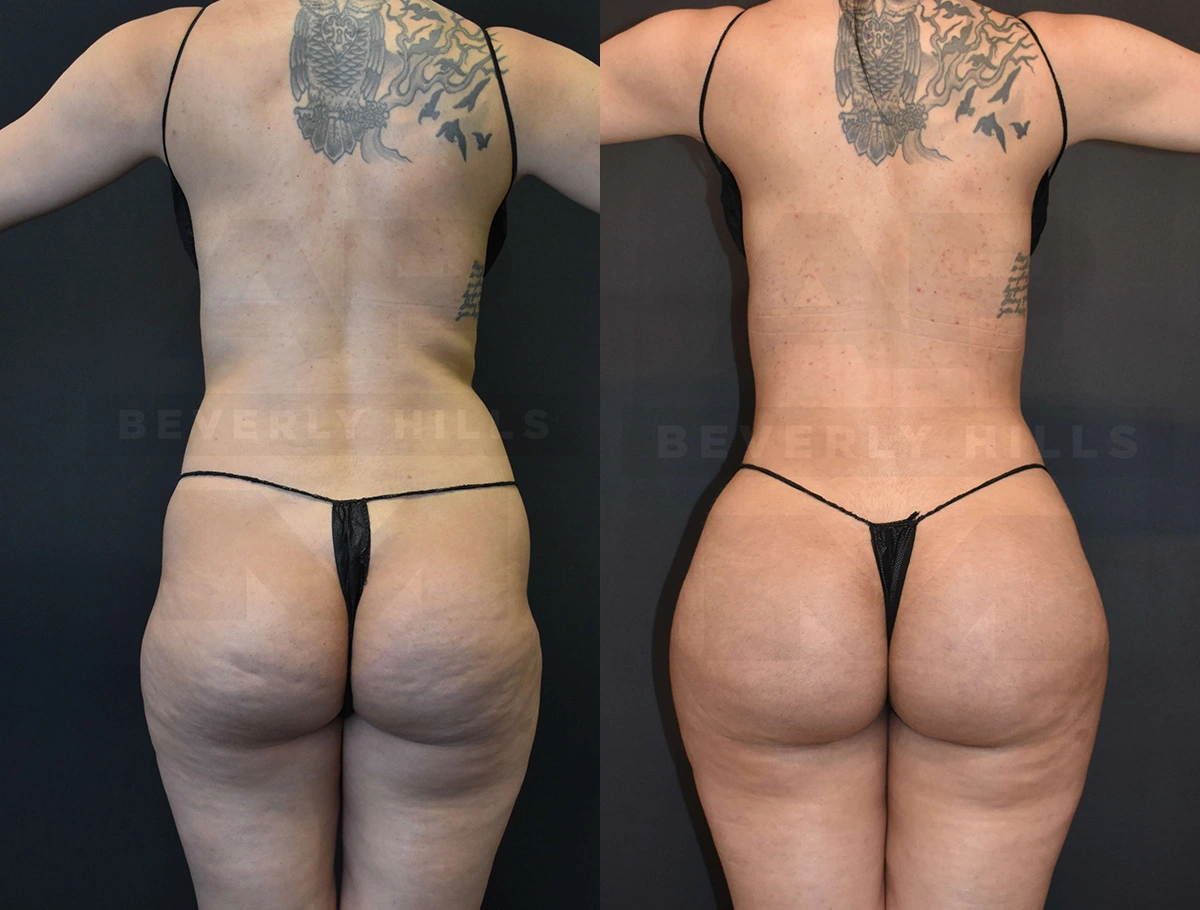 Real Patient Results of Dr. Andre P. Marshall providing Plastic Surgery services to his Beverly Hills & Los Angeles patients.