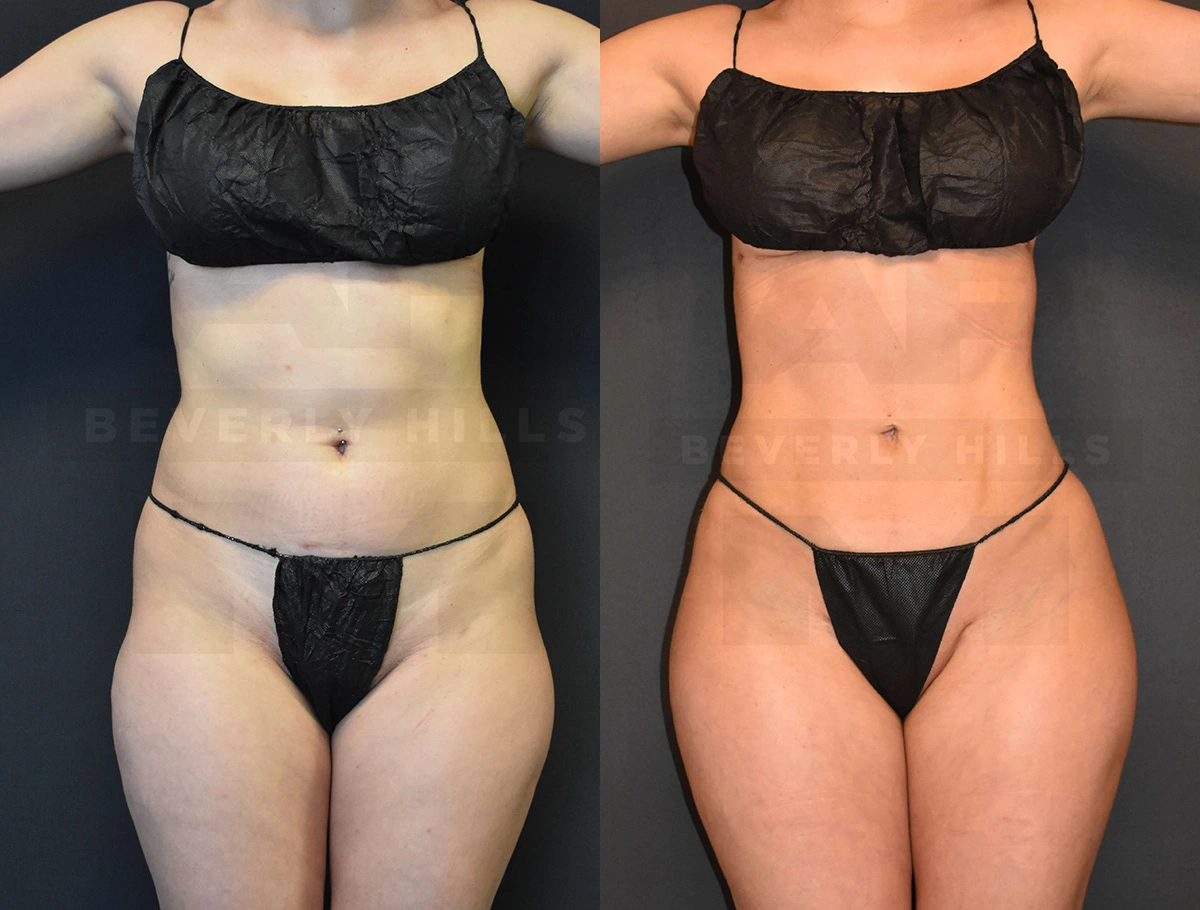 Real Patient Results of Dr. Andre P. Marshall providing Plastic Surgery services to his Beverly Hills & Los Angeles patients.