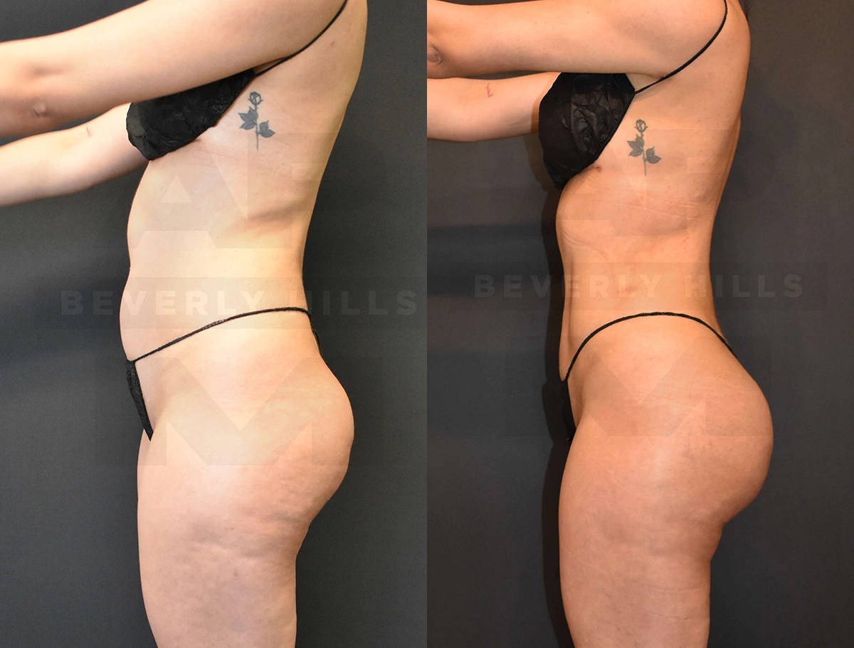 Real Patient Results of Dr. Andre P. Marshall providing Plastic Surgery services to his Beverly Hills & Los Angeles patients.